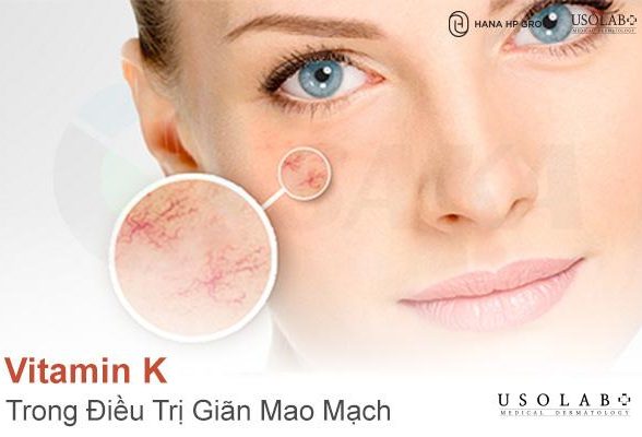 Vitamin K trong Điều Trị Giãn Mao Mạch – Giải Pháp Củng Cố Thành Mạch Máu