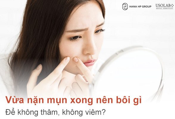 vừa nặn mụn xong nên bôi gì